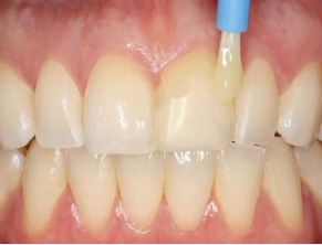 该不该给孩子牙齿"涂氟"