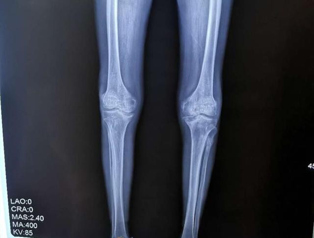 男子双膝关节严重变形罪魁祸首竟是坚持多年的习惯