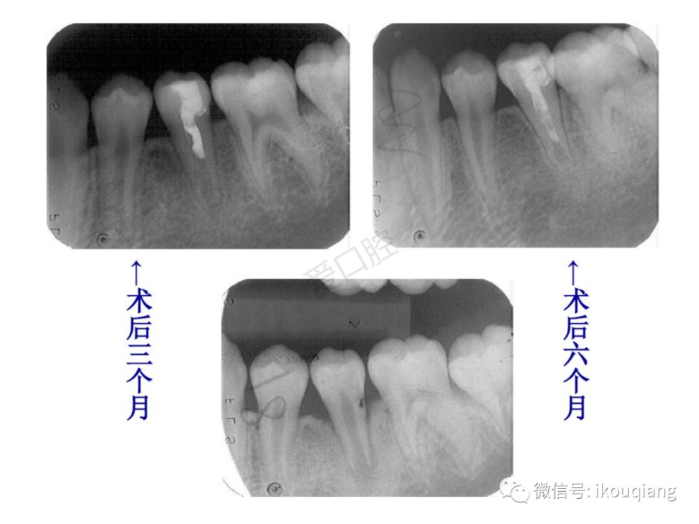 图解根尖诱导成形术_腾讯新闻