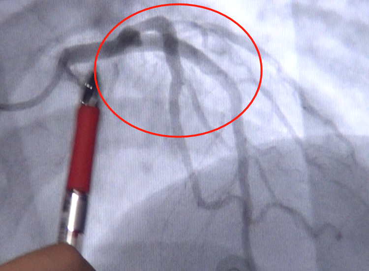 支架术后,血液很顺利,也很充分的沿着前降支的主干道分布到了整个心脏