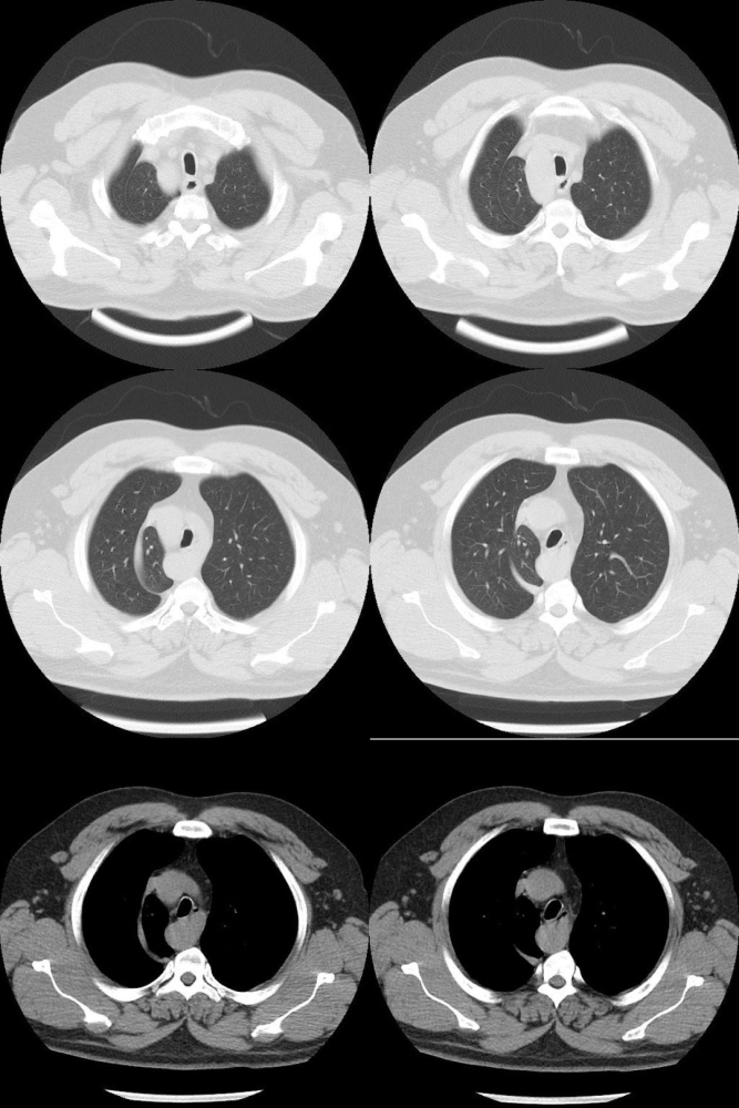 多出来的肺裂,你认识几个?