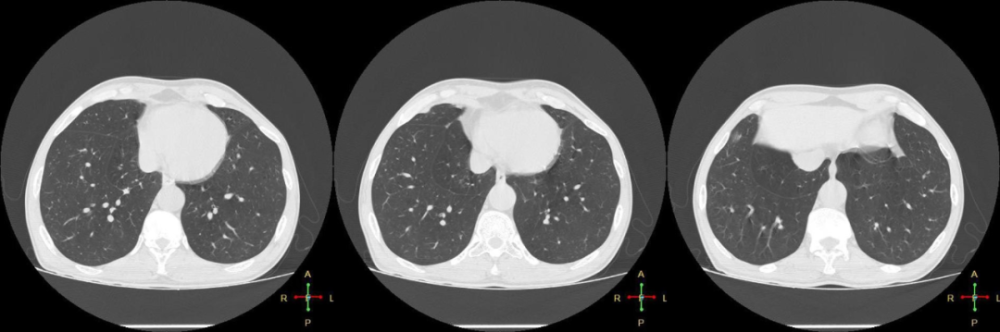 多出来的肺裂,你认识几个?
