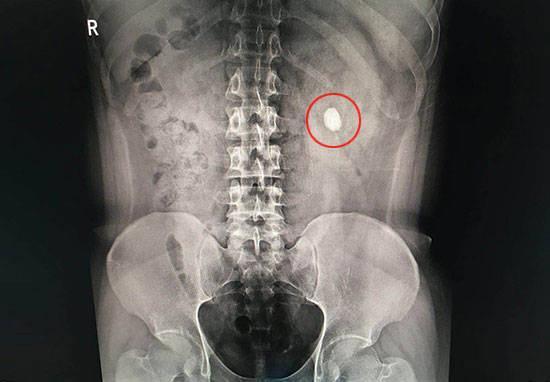 部位,形态等,没有b超我们选x线,泌尿系平片(kub)能发现95%以上的绞