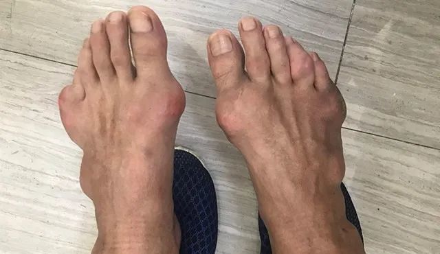 贵州户口恭喜了痛风患者冬季专项补贴正式发放截止28日