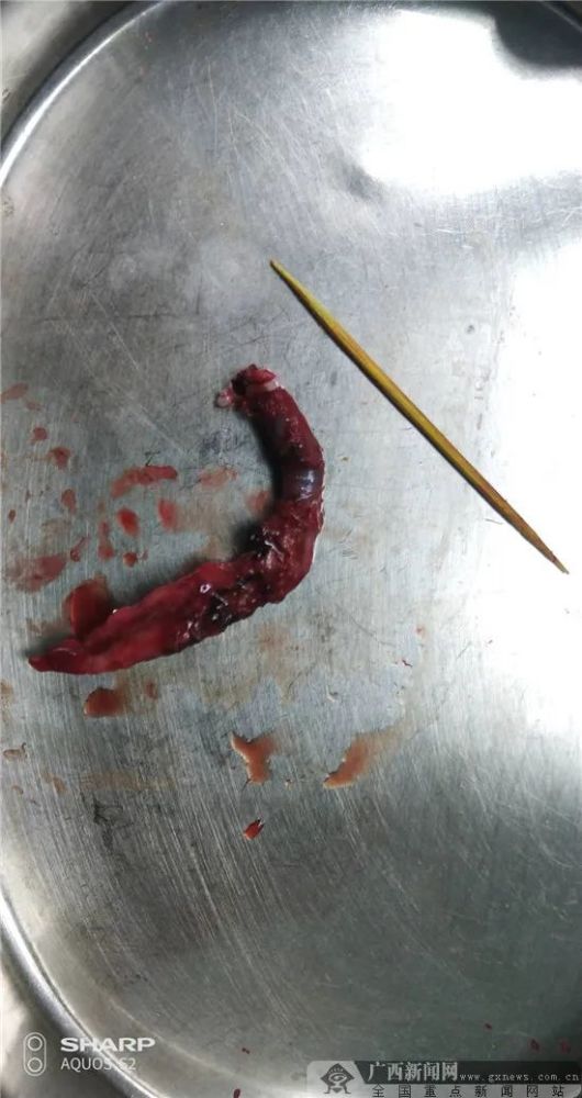 南宁一男子误吞牙签7天后发现肠子已被刺穿危及生命