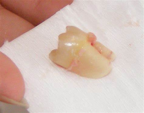 智齿在局麻下拔除后,空虚的拔牙窝由血凝块填塞,随着时间的发展,血