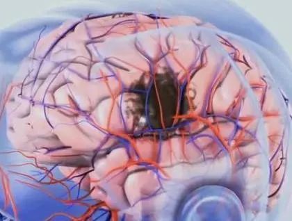 脑梗塞|为什么越来越多的人得脑梗？三件事是“祸根”，劝你别做