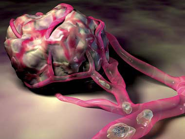 唐氏综合症|科学家发现与唐氏综合征异常相关的基因可能对实体肿瘤有保护作用