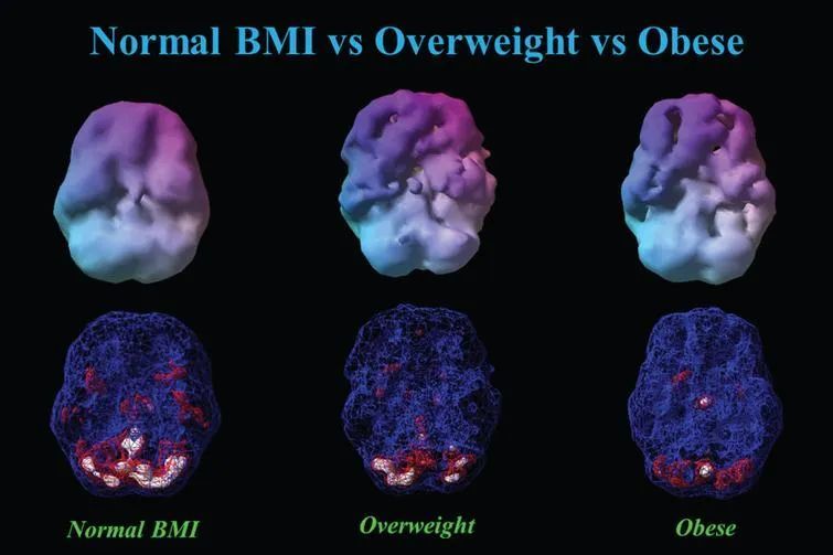 体重对大脑影响多大 3 5万次大脑扫描结果惊人 腾讯新闻