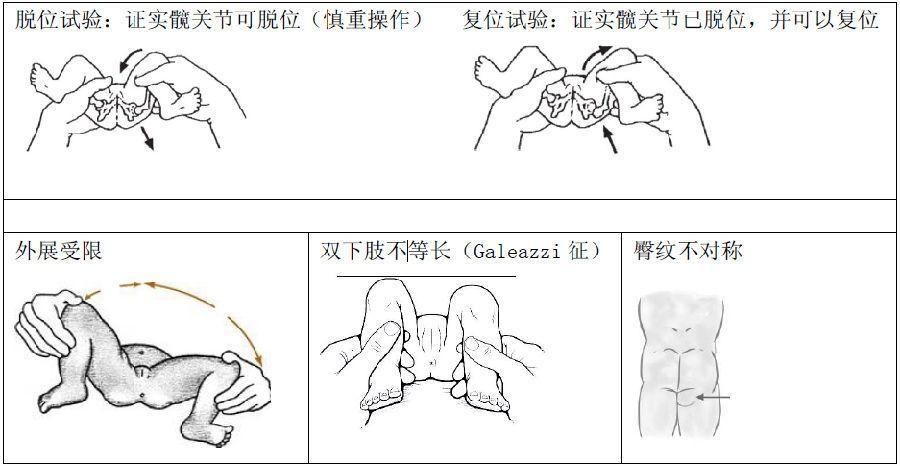 正常嬰兒雙側髖關節外展對稱且能到達80-90度,髖關節發育不良患兒外展