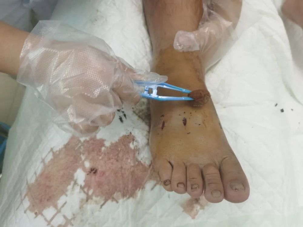 贵州小伙凌晨感觉脚下一阵刺痛低头一看腿肿成这样