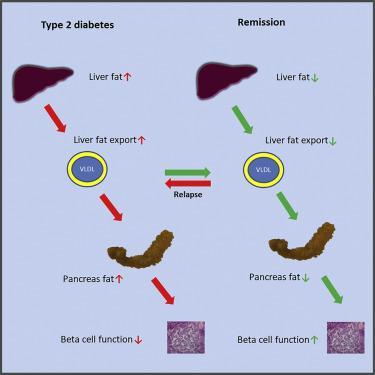 2型糖尿病|科学家首次观察到2型糖尿病的形成过程；证实减重可促进2型逆转！