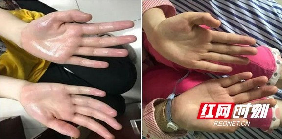 手汗症|双手长期湿漉漉 原来是这个病