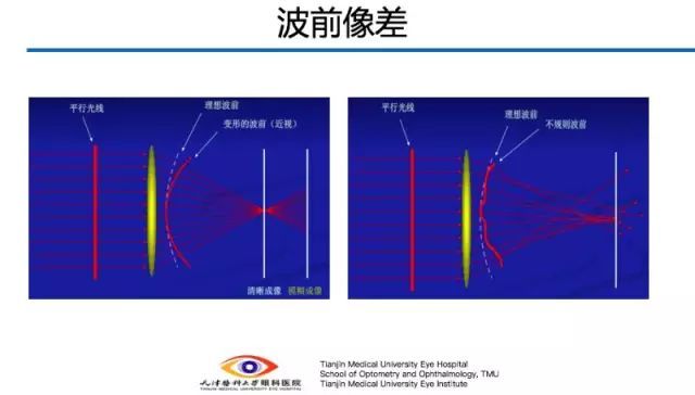 【眼视光】人眼波前像差