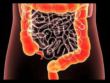 烏魯木齊遠大肛腸醫院:怎樣來預防腸息肉的發生?