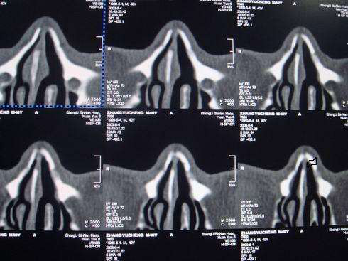 鼻骨骨折的治疗 鼻骨骨折 外伤 鼻腔 骨质