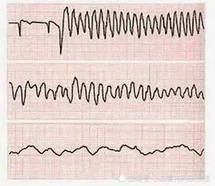 无脉性室速典型心电图图片
