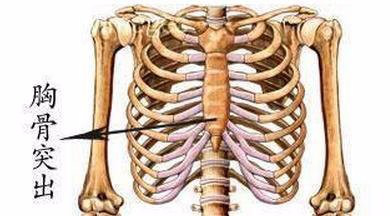 鸡胸|鸡胸的治疗与预防
