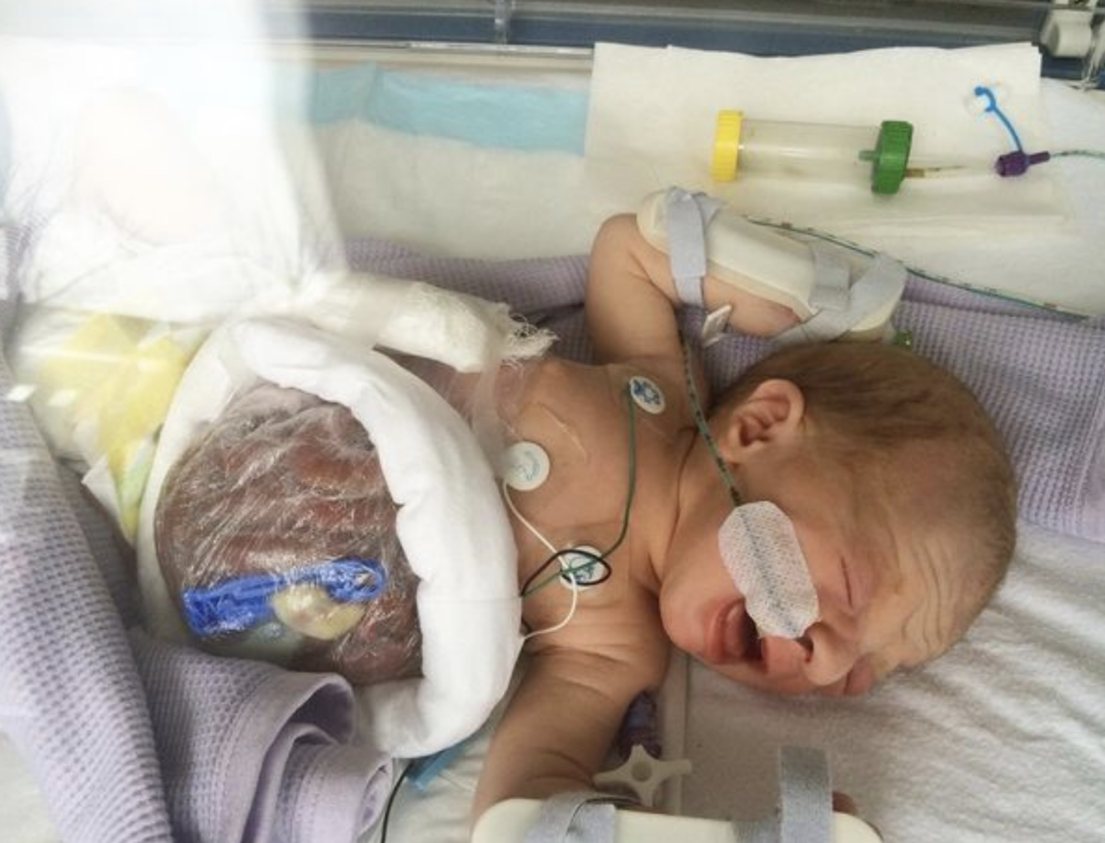 英国_社会|英国男孩出生时肠子和胃都在体外，只有5％存活率，如今康复出院