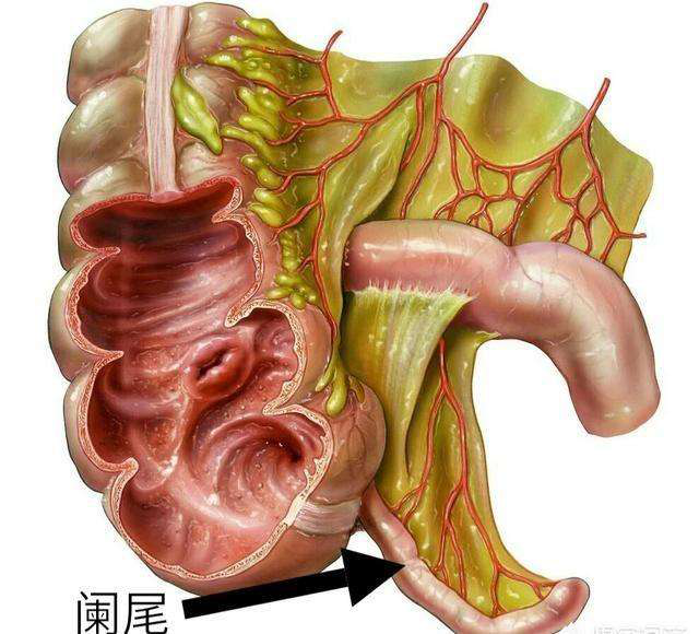 阑尾炎的病因及症状