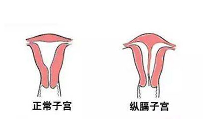 子宫发育异常都有哪些症状?日常中怎样预防?