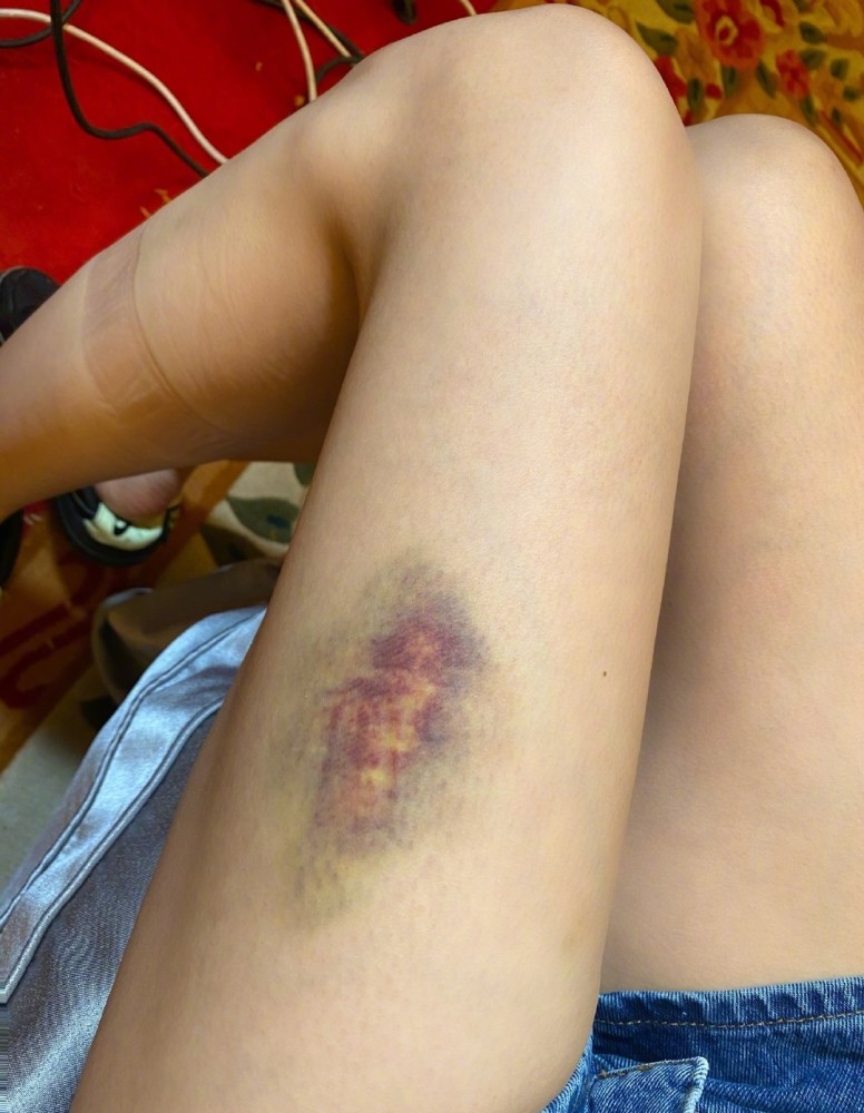 继沈梦辰后陈小纭晒受伤照,被打到没法看,艺人为表现好有多拼?