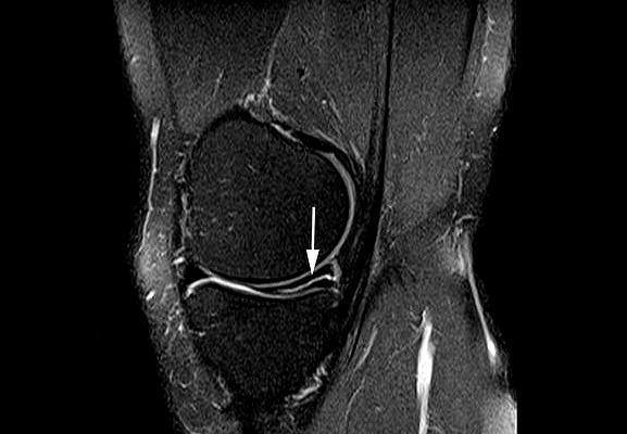 膝关节|半月板撕裂术后复查核磁，为何还能看见“损伤信号”？医生告诉您