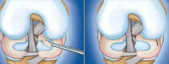 膝关节|半月板撕裂术后复查核磁，为何还能看见“损伤信号”？医生告诉您