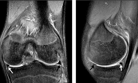 膝关节|半月板撕裂术后复查核磁，为何还能看见“损伤信号”？医生告诉您