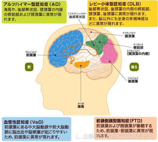 痴呆症 認知症 Dementia 腾讯新闻