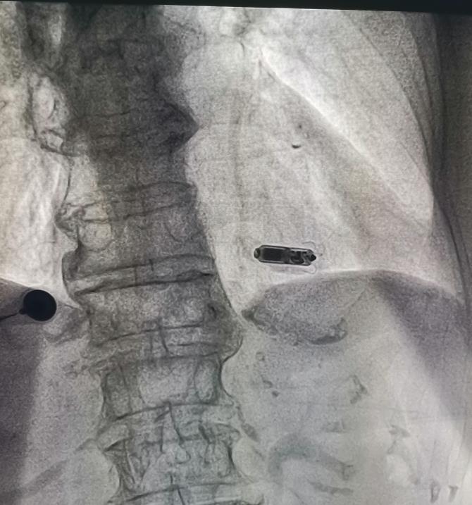 起搏器|不足2克“胶囊”让心脏搏动超12年 88岁奶奶成功植入无导线起搏器