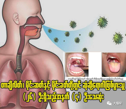 掸邦有26人患"白喉病,4人死亡;实皆省新增1例新冠肺炎患者