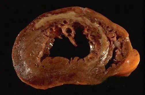 左心室肥厚|心脏超声报了“左心室肥厚”，严重吗？给你一份详细的评估流程