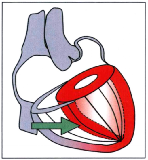 左心室肥厚|心脏超声报了“左心室肥厚”，严重吗？给你一份详细的评估流程