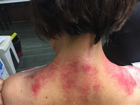 达到局部淤血变化的方法,其实还有很多种,包括常用的刮痧,抓痧,拍打等