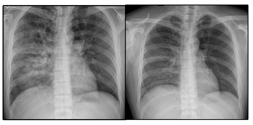肺水肿的x线表现图片图片