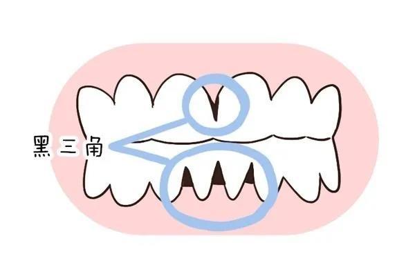 你的牙缝里有没有黑三角快去对号入座