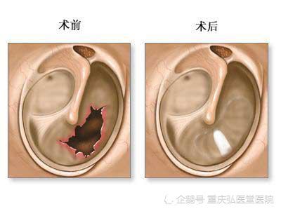 重庆弘医堂耳鼻喉医院讲解 鼓膜穿孔的正确护理方法 腾讯新闻