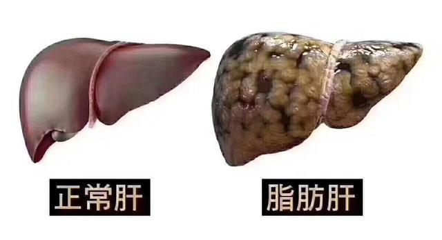 哪些人容易患脂肪肝 脂肪肝有什么危害呢 腾讯新闻