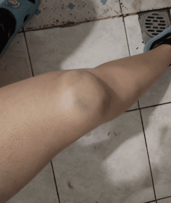 有点慌溜冰摔的膝盖鼓起一个大包哈哈专业团队可以抬走了