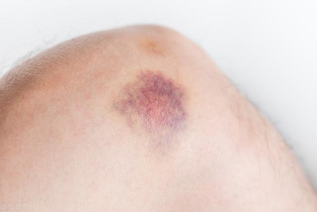 7,肝硬化若经常酗酒,患有肝炎疾病且皮肤瘀青,需警惕肝硬化.