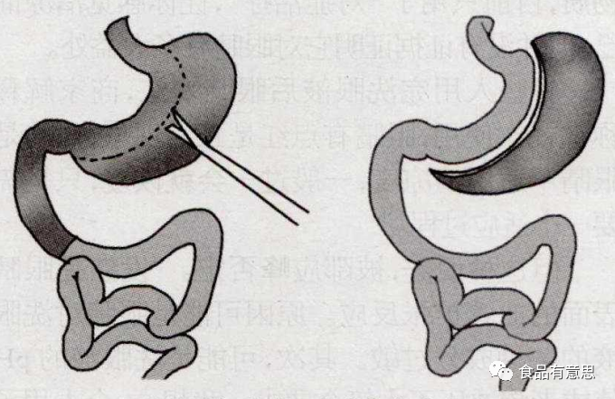 杨天真|杨天真切胃根治糖尿病，切胃比自律更划算吗？