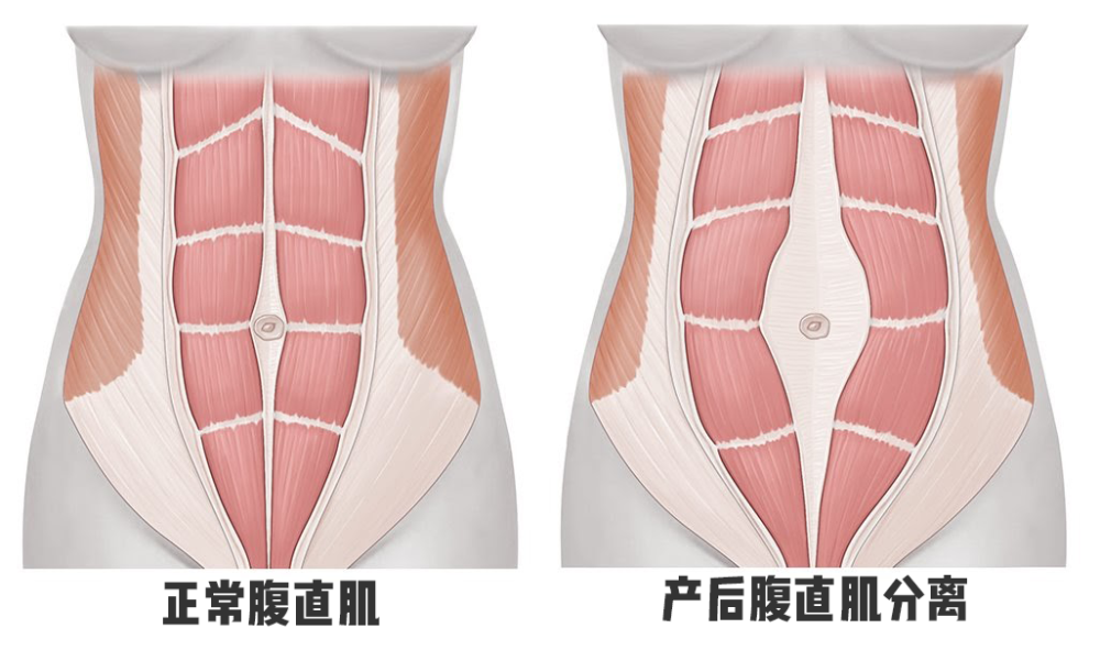 妈妈们请关注腹直肌分离的危害及预防 腾讯新闻