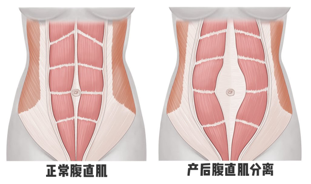 妈妈们请关注腹直肌分离的危害及预防 腹直肌分离 腹直肌