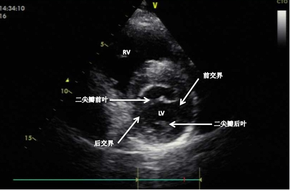 左心室短轴切面实际为一组切面,分为二尖瓣水平,乳头肌水平以及心尖