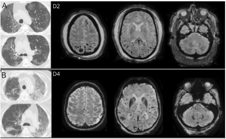 新冠病毒|新冠病毒入侵人体高级“司令部”真相