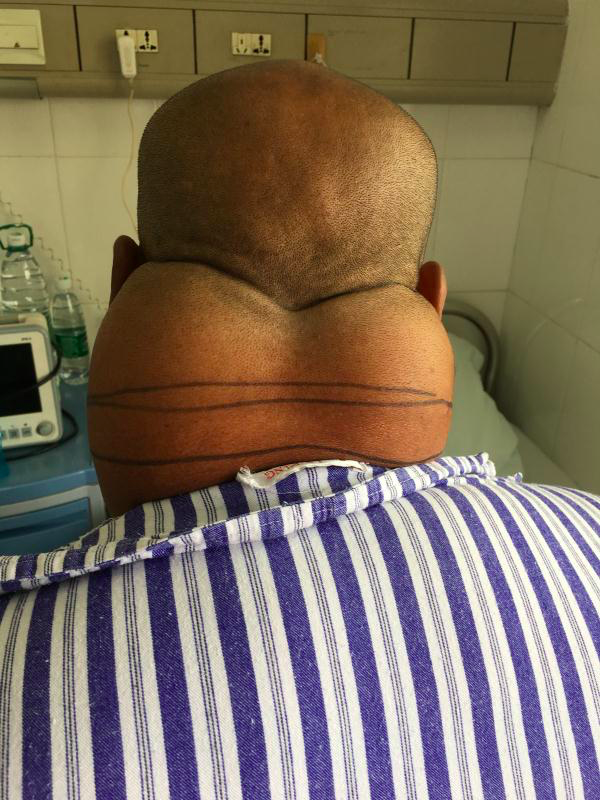 男子脂肪狂长堆成"绿巨人",原来患上全球罕见"马德龙病"