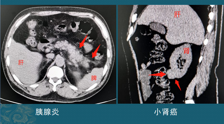 车祸住院查出早期肾癌该起诉肇事者还是写个感谢信