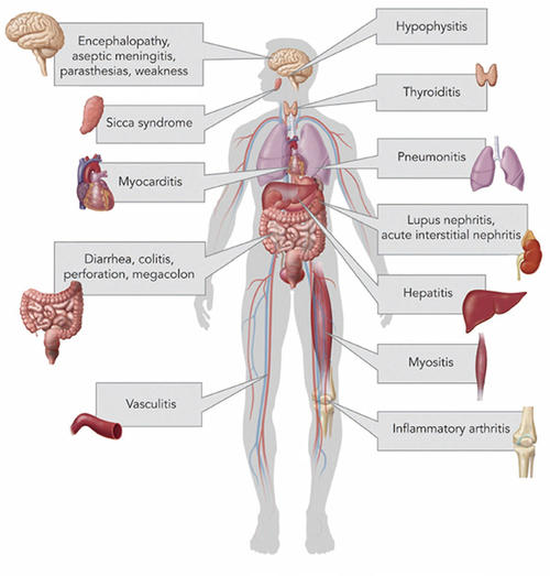 吉兰巴雷综合征的病因以及预后情况