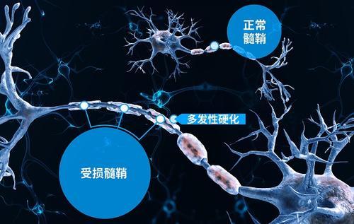 康复治疗|康复专家：多发性硬化患者的康复治疗